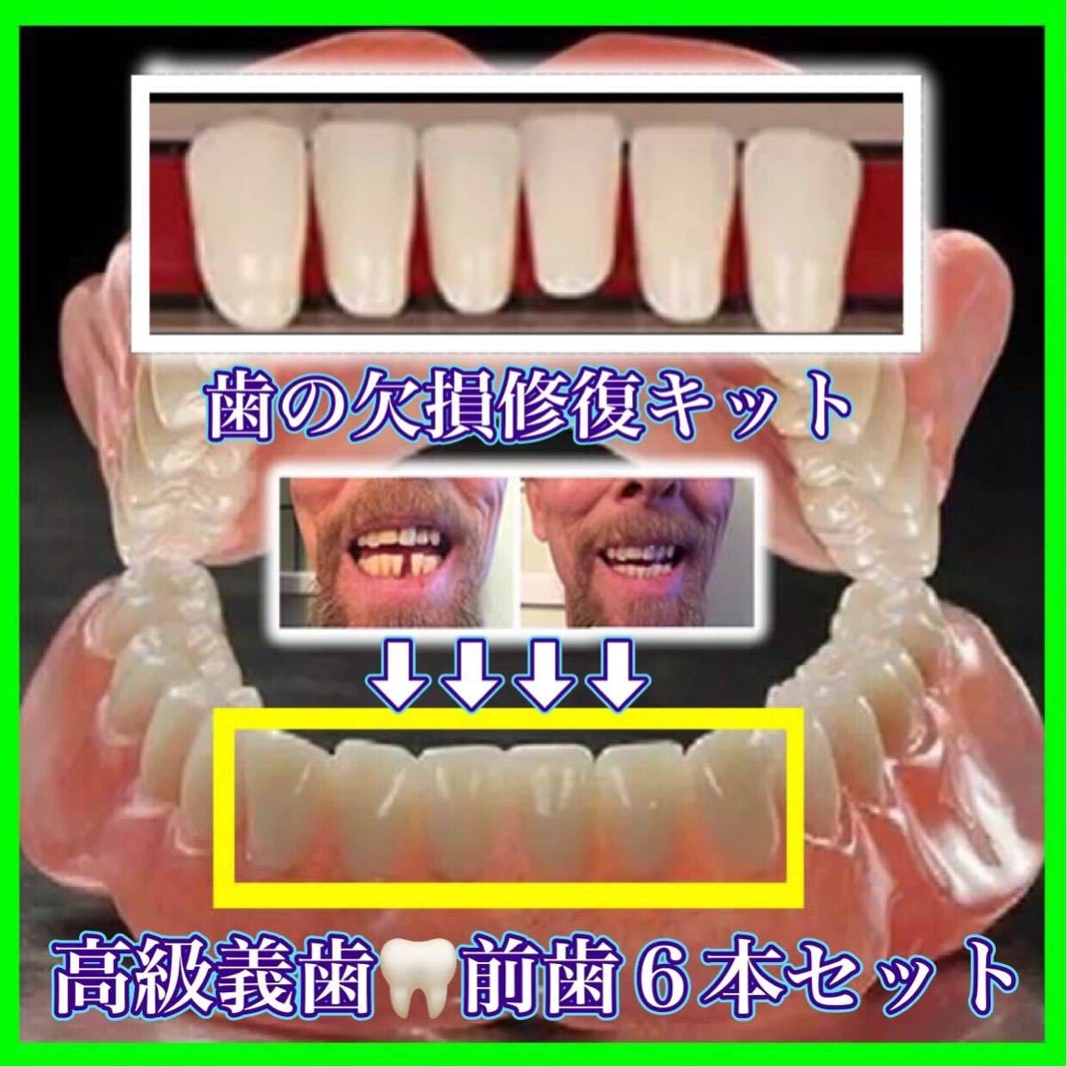 歯の欠損修復 高品質樹脂製（前歯下段6本）高級義歯全6個セット 義歯