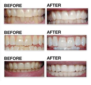 ★ Crest 3D WHITE 20回分 ホワイトニング クレスト　2017/4