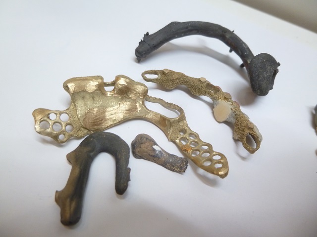 〓歯科金属スクラップ 焼成屑 撤去冠 除去冠 湯だまり 白金 鋳造屑  