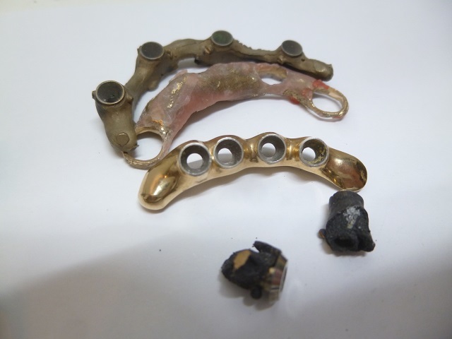 〓歯科金属スクラップ 焼成屑 撤去冠 除去冠 湯だまり 白金 鋳造屑  