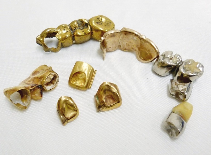 20 104-534037-08 [Y] 金歯 銀歯 オーラルケア まとめて 総重量 ブリッジ 被せ物 約29.65g 長104