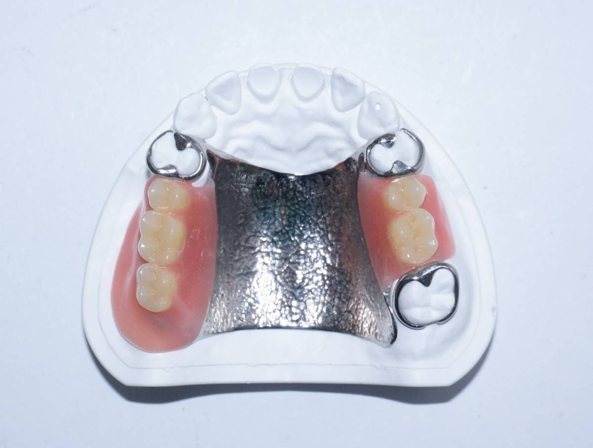 歯科 部分床義歯 パーシャルデンチャー サンプル 模型 見本 入れ歯
