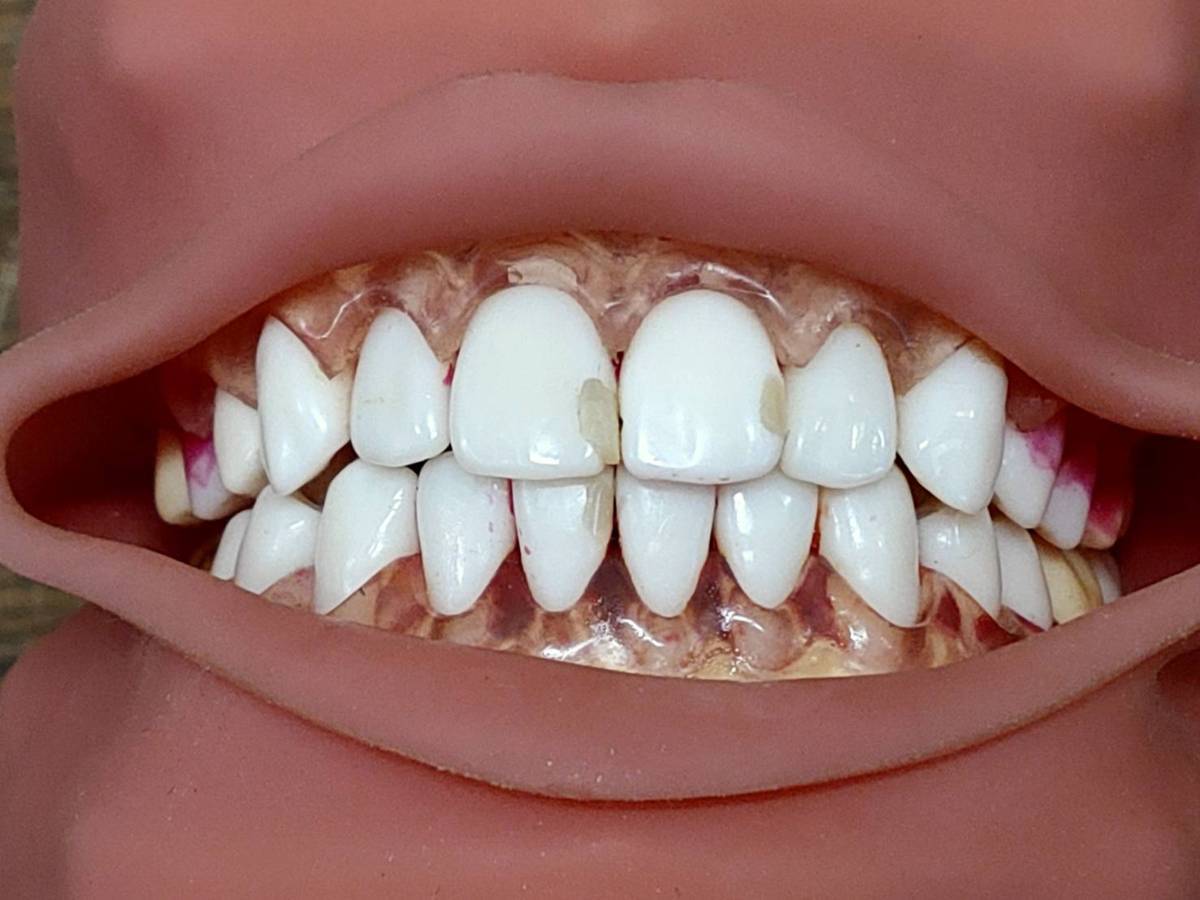 □送料無料□ ニッシン DENTAL MODEL P15FE-206H.1(GSF) デンタル