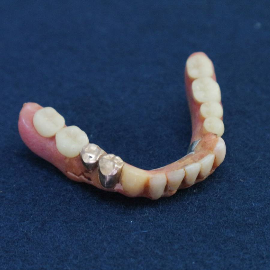 金歯 2本 入れ歯 歯科材料 つぶし◆731f15