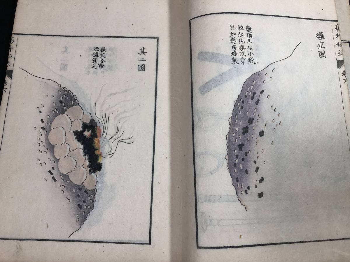 8894医学 彩色木版画 外科手術道具 腫瘍ほか絵入 全10巻10冊揃 □瘍科 