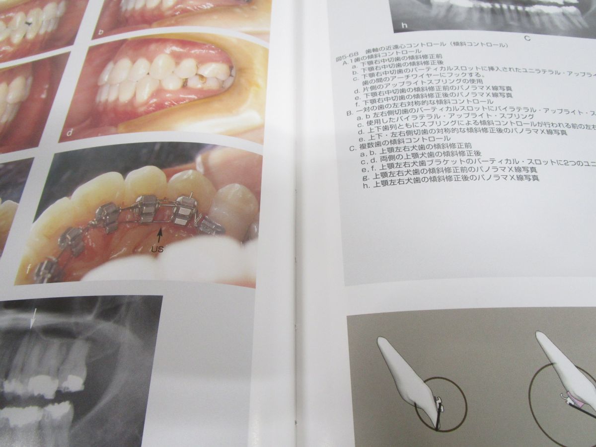 裁断済み】リンガルブラケット矯正の臨床 リンガルブランケット矯正の
