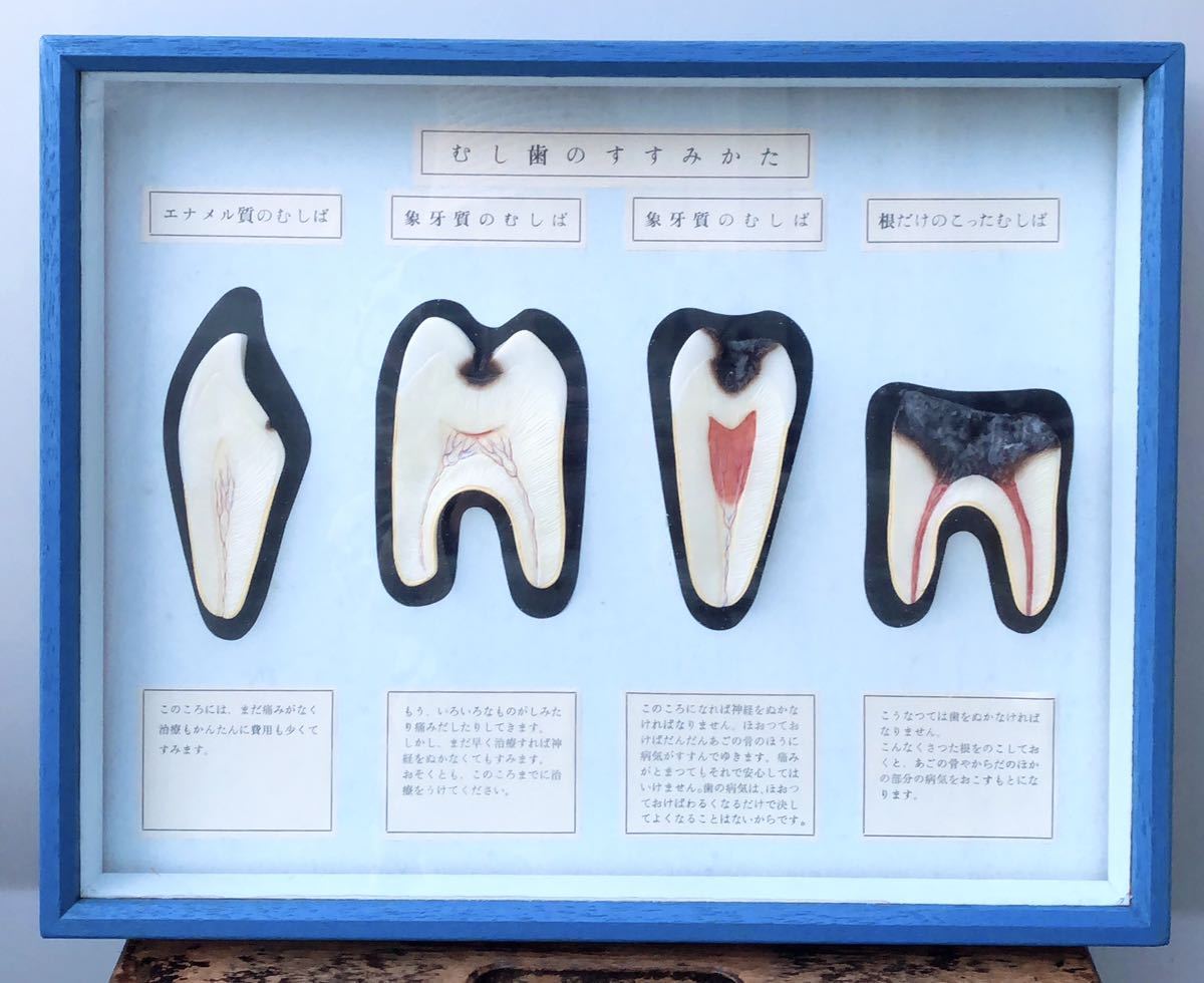 未使用保管品☆箱付き yagami むし歯のすすみ方 虫歯 歯医者 模型 標本 