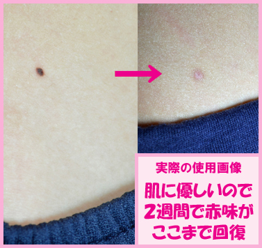 【送料無料】 ホクロの悩み解消ジェル 『ハーフ品』 期間限定!r_2